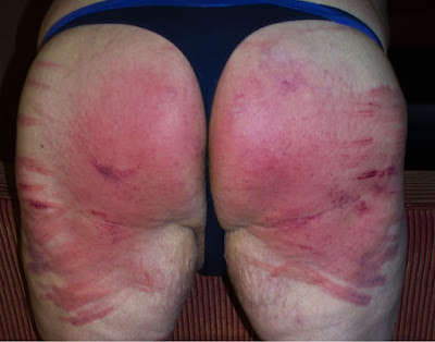 marked bottom after spanking